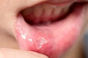 درمان آفت دهان با طب سنتی و گیاهان دارویی