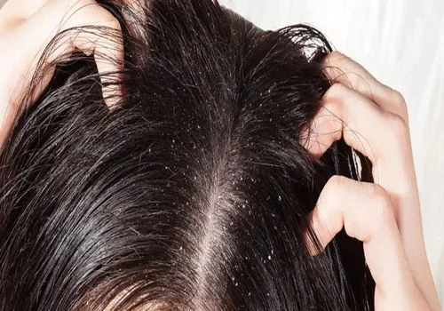رفع چربی مو و پوست سر به روش خانگی