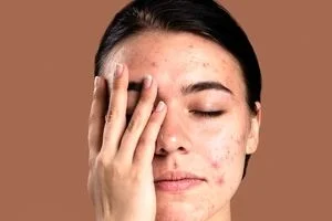 مزاج چه تاثیری روی جوش های پوستی و بدن داره؟ 